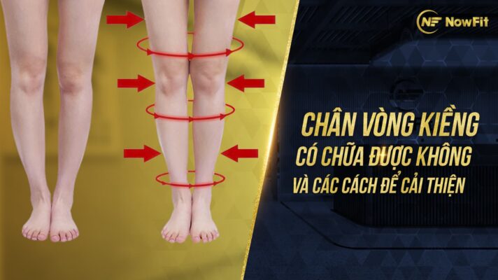 Chân vòng kiềng có chữa được không và các cách để cải thiện-01-min