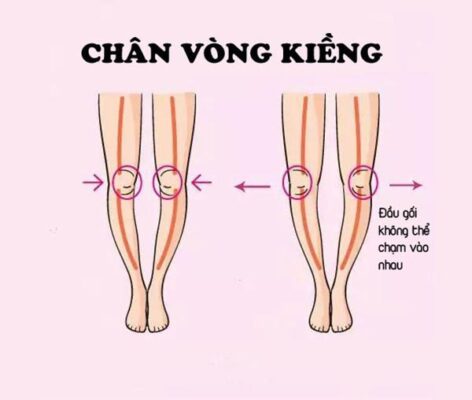 Nguyên nhân bị chân vòng kiềng