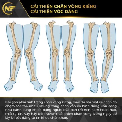 ​CHÂN VÒNG KIỀNG