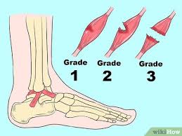 Lật sơ mi cổ chân là gì và cách điều trị 