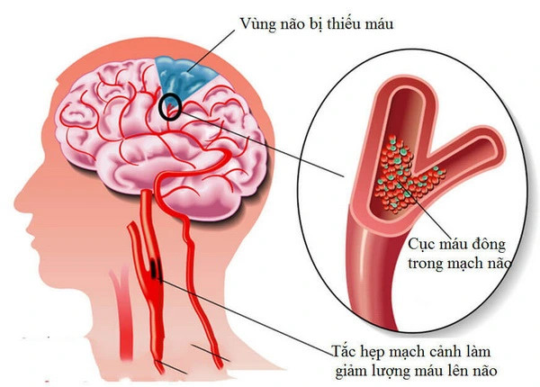 Dấu hiệu của thiếu máu não là gì